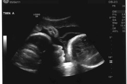 Снимок УЗИ на 36 неделе беременности 