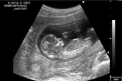УЗИ эмбриона на 20 недели беременности