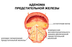 Аденома предстательной железы
