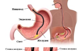 Эндоскопическое УЗИ желудка