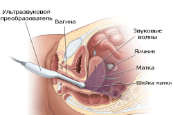Трансвагинальное УЗИ при беременности на ранних сроках